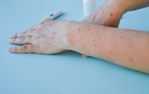 Mpox disease