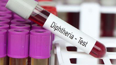 Diphtheria